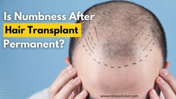 Are Numbness After Hair Transplant and Nerve Damage Permanent? Here is the Answer