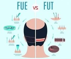 Everything to Know About FUE Hair Transplants