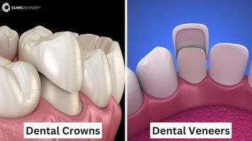 Dental Crowns vs. Veneers