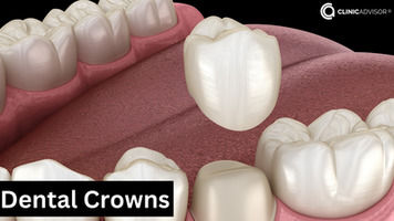 Dental Crowns