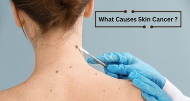 Skin Cancer Causes