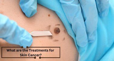 Skin Cancer Treatments