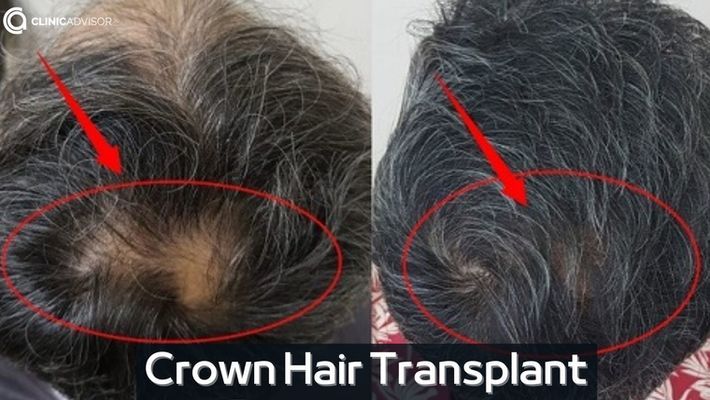 Crown Hair Transplant