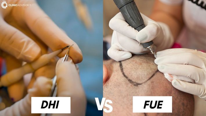 DHI vs FUE hair transplants: Explained by surgeons