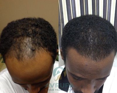 Afro Hair Transplant in Istanbul: FUE Nuances, Surgeon Expertise & 11-Month Results