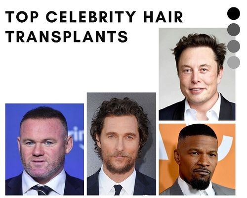 10 Natural-Looking Celebrity  Hair Transplant Results