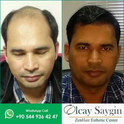 15% discount on hair transplant online reservation