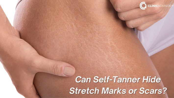 Can self-tanner cover scars or stretch marks