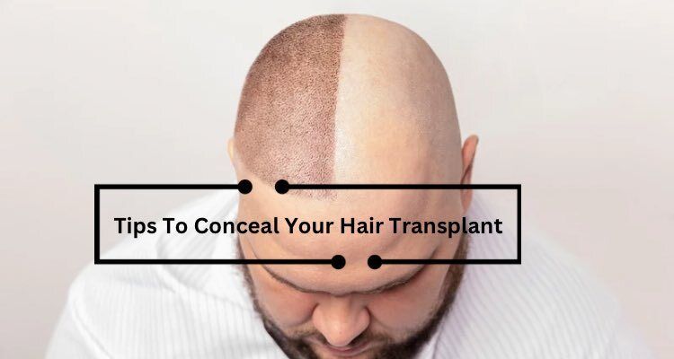 How to Conceal Your Hair Transplant: Using Hats for Privacy and Confidence