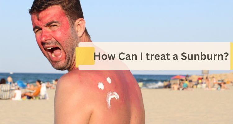How to Treat a Sunburn ?