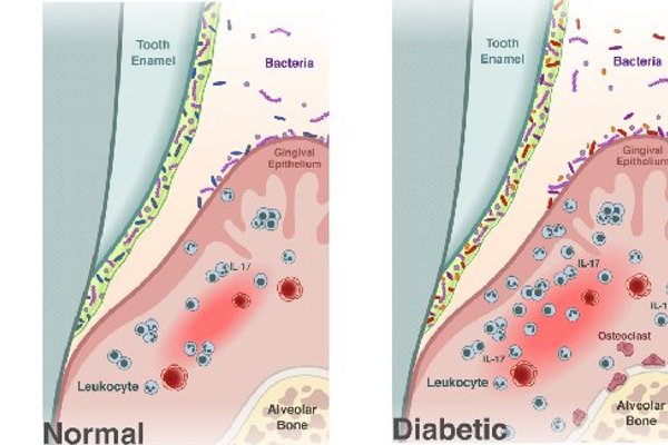 Diabetes causes shift in oral microbiome that fosters periodontitis, study finds Diabetes causes shift in oral microbiome that fosters periodontitis, study finds