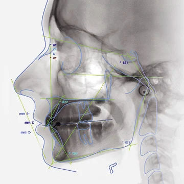 Analyse Céphalométrique Assistée par IA - Module Orthodontie Dentolio