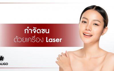 กำจัดขนด้วยเครื่อง Laser