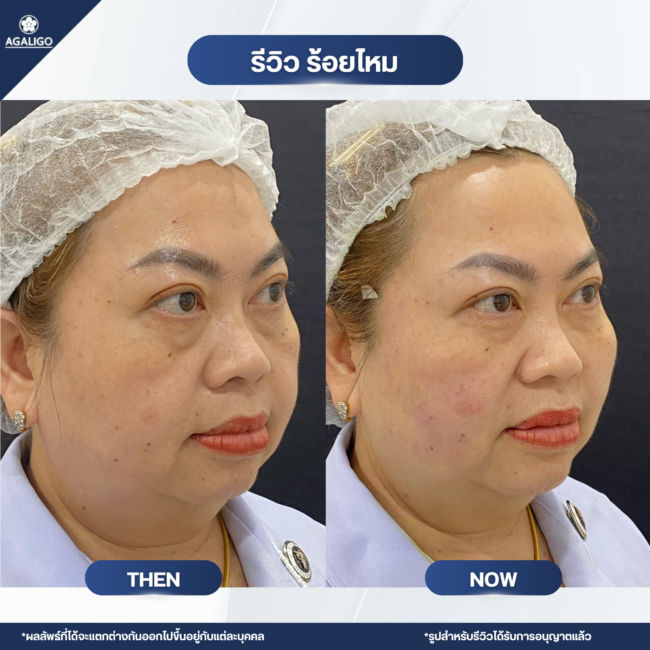 ร้อยไหม รีวิว ร้อยไหม อะกาลิโก 05