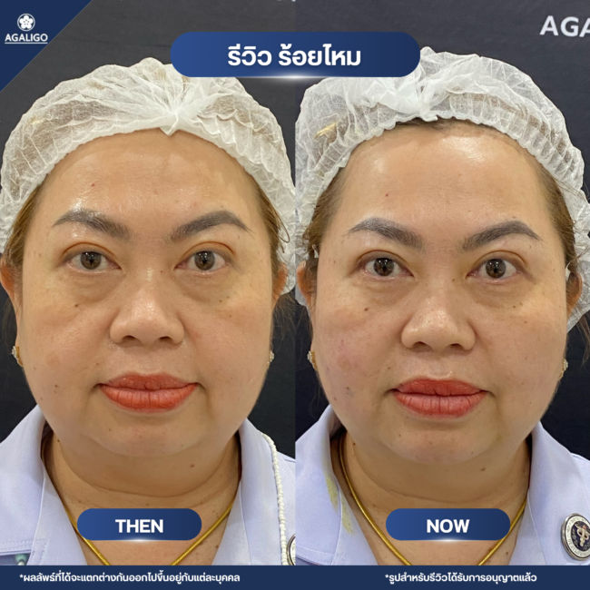 ร้อยไหม รีวิว ร้อยไหม อะกาลิโก 04