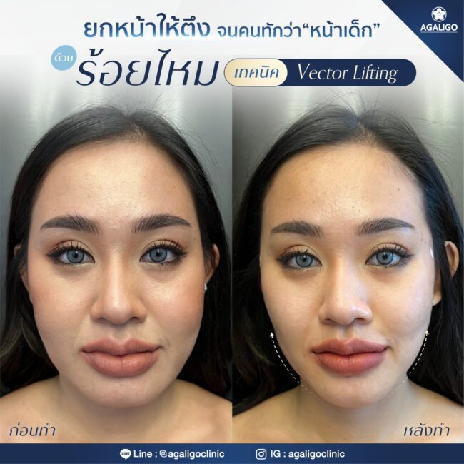 ร้อยไหม รีวิว ร้อยไหม อะกาลิโก 03