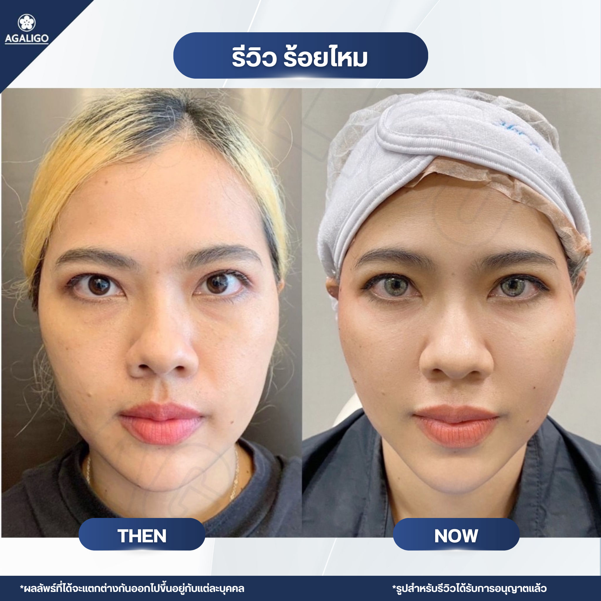 ร้อยไหม รีวิว ร้อยไหม อะกาลิโก 10