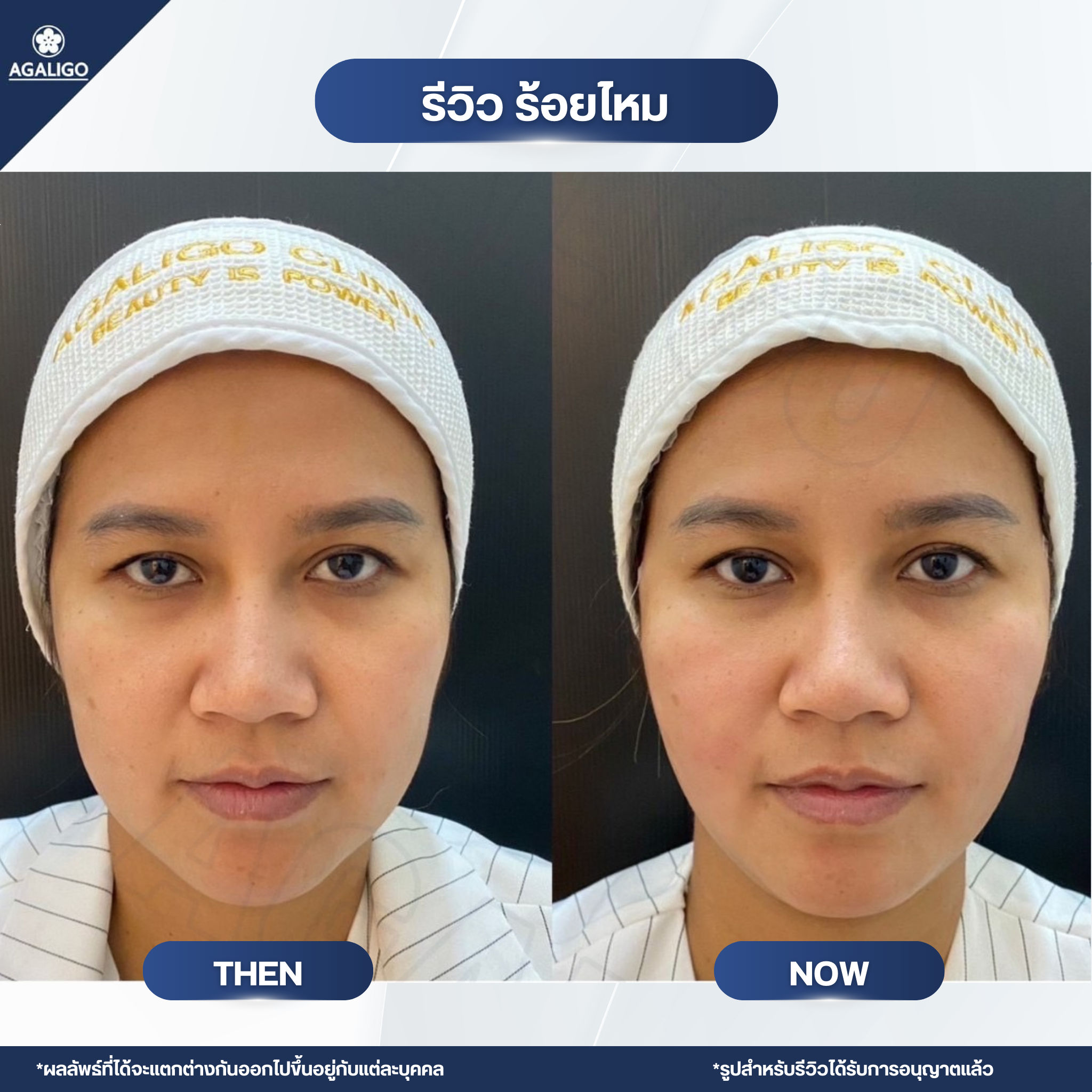 ร้อยไหม รีวิว ร้อยไหม อะกาลิโก 08