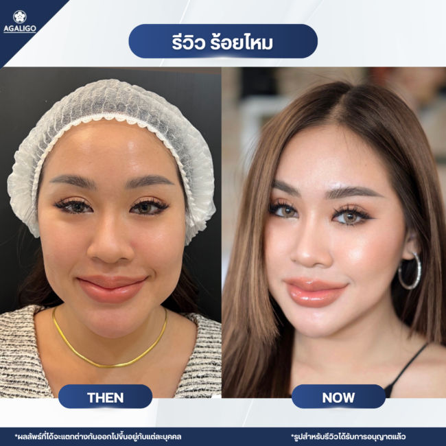 ร้อยไหม รีวิว ร้อยไหม อะกาลิโก 07