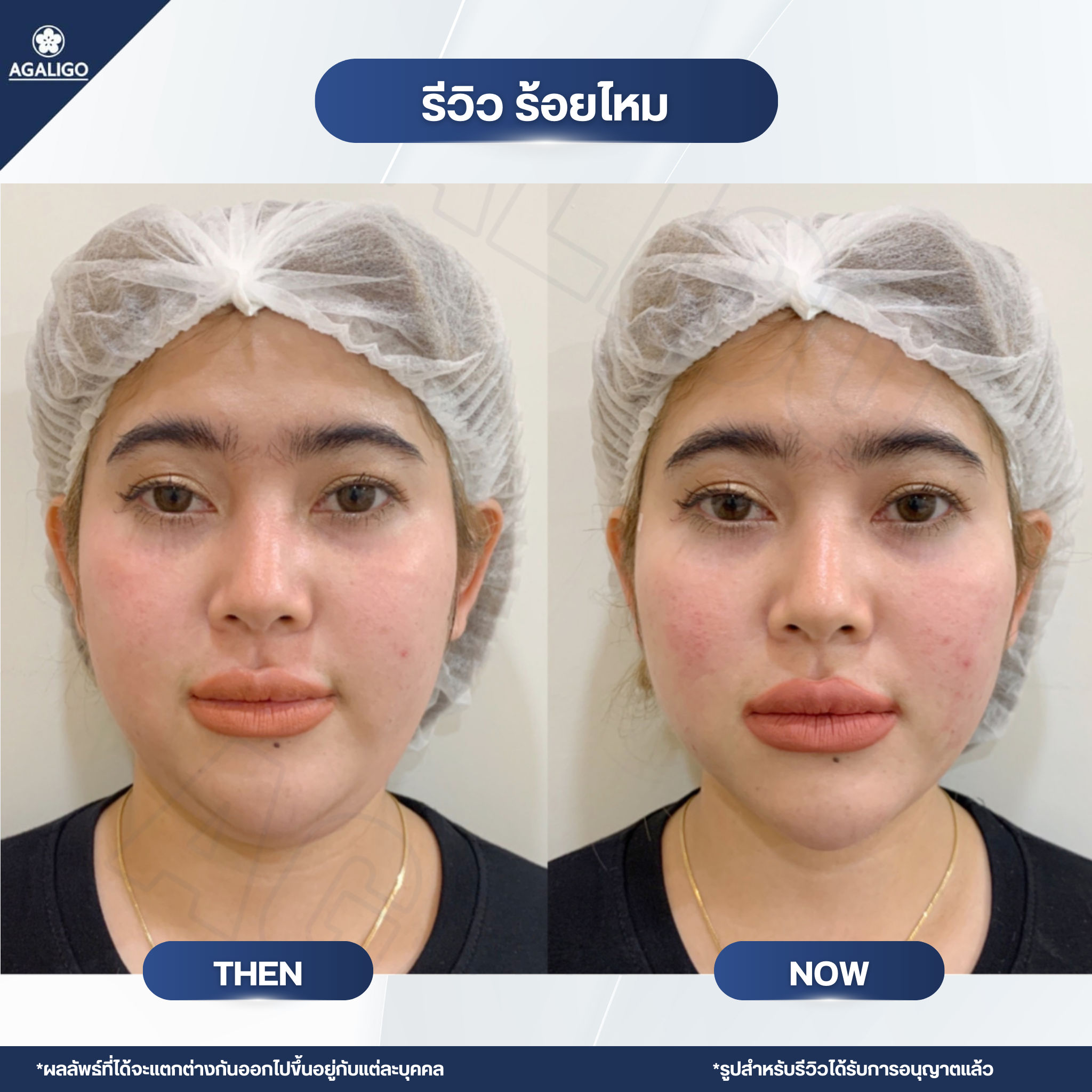 ร้อยไหม รีวิว ร้อยไหม อะกาลิโก 06