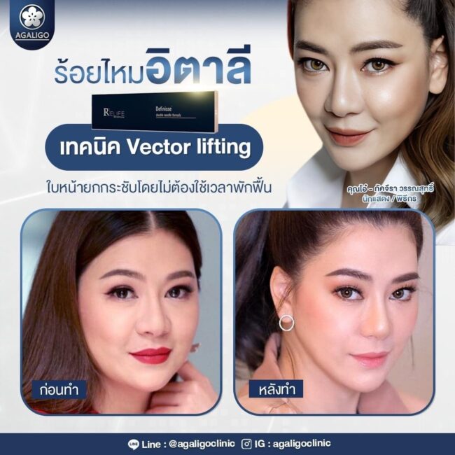 ร้อยไหม รีวิว ร้อยไหม อะกาลิโก 02