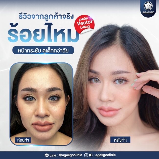 ร้อยไหม รีวิว ร้อยไหม อะกาลิโก 01