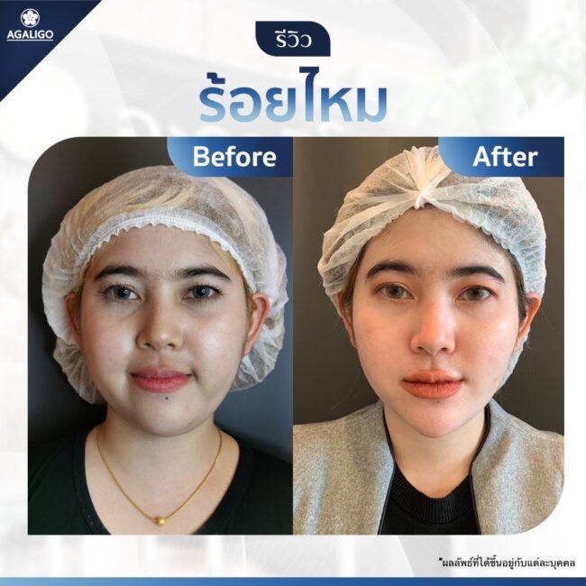 ร้อยไหม รีวิว ร้อยไหม อะกาลิโก