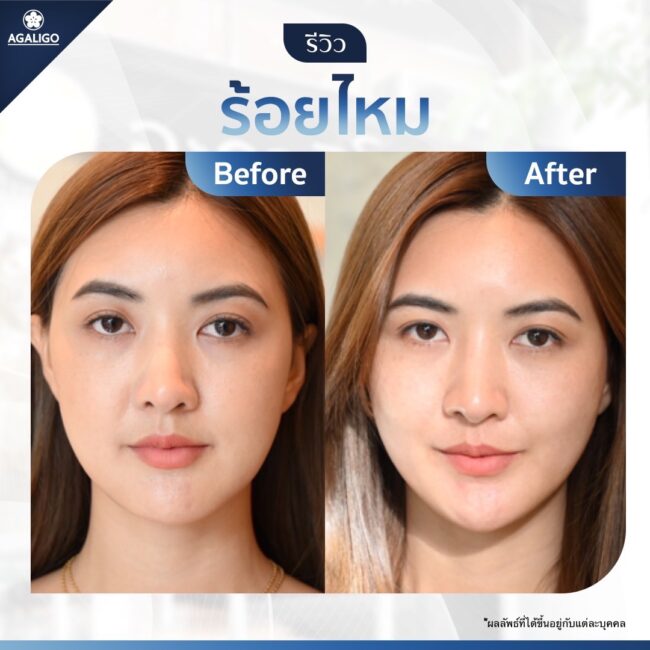 รีวิวร้อยไหม อะกาลิโก 4