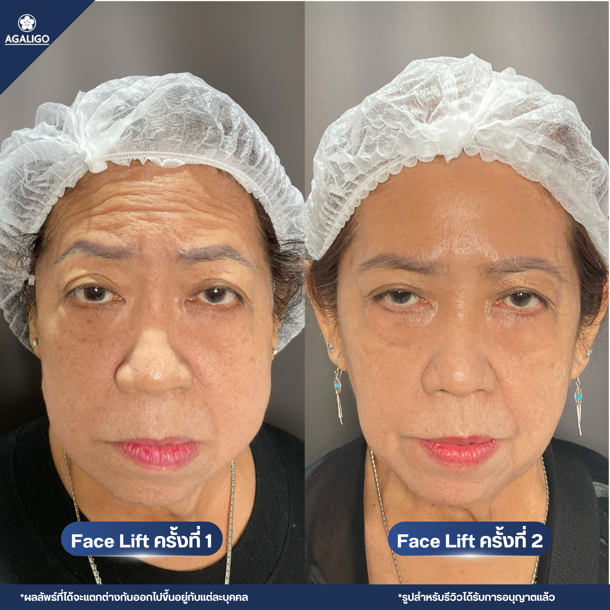 รีวิวร้อยไหม อะกาลิโก 3