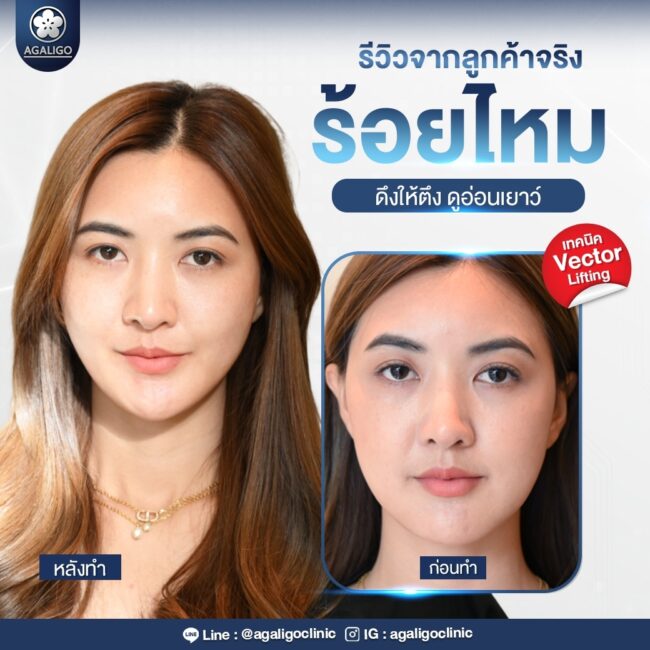 รีวิวร้อยไหม อะกาลิโก 2