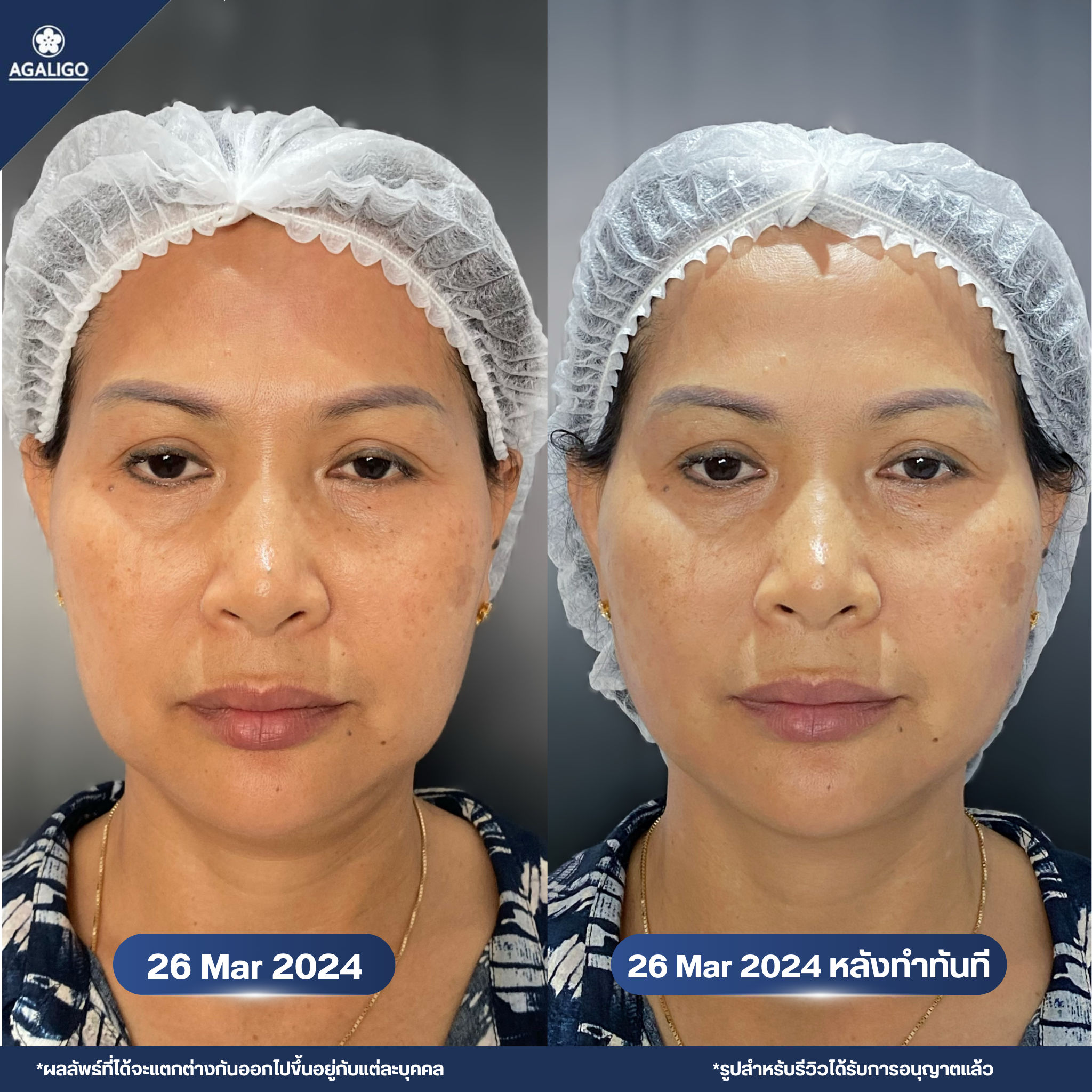 รีวิวร้อยไหม อะกาลิโก 1