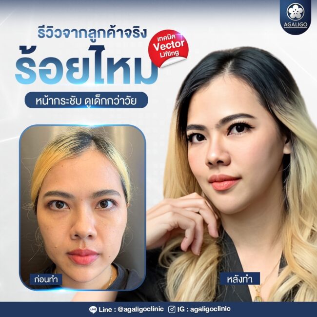 รีวิวร้อยไหม อะกาลิโก