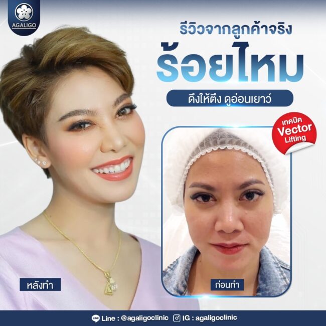 ร้อยไหม รีวิว ร้อยไหม อะกาลิโก 11