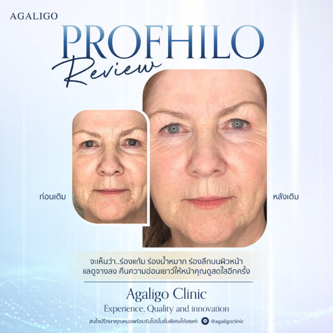 Profhilo review