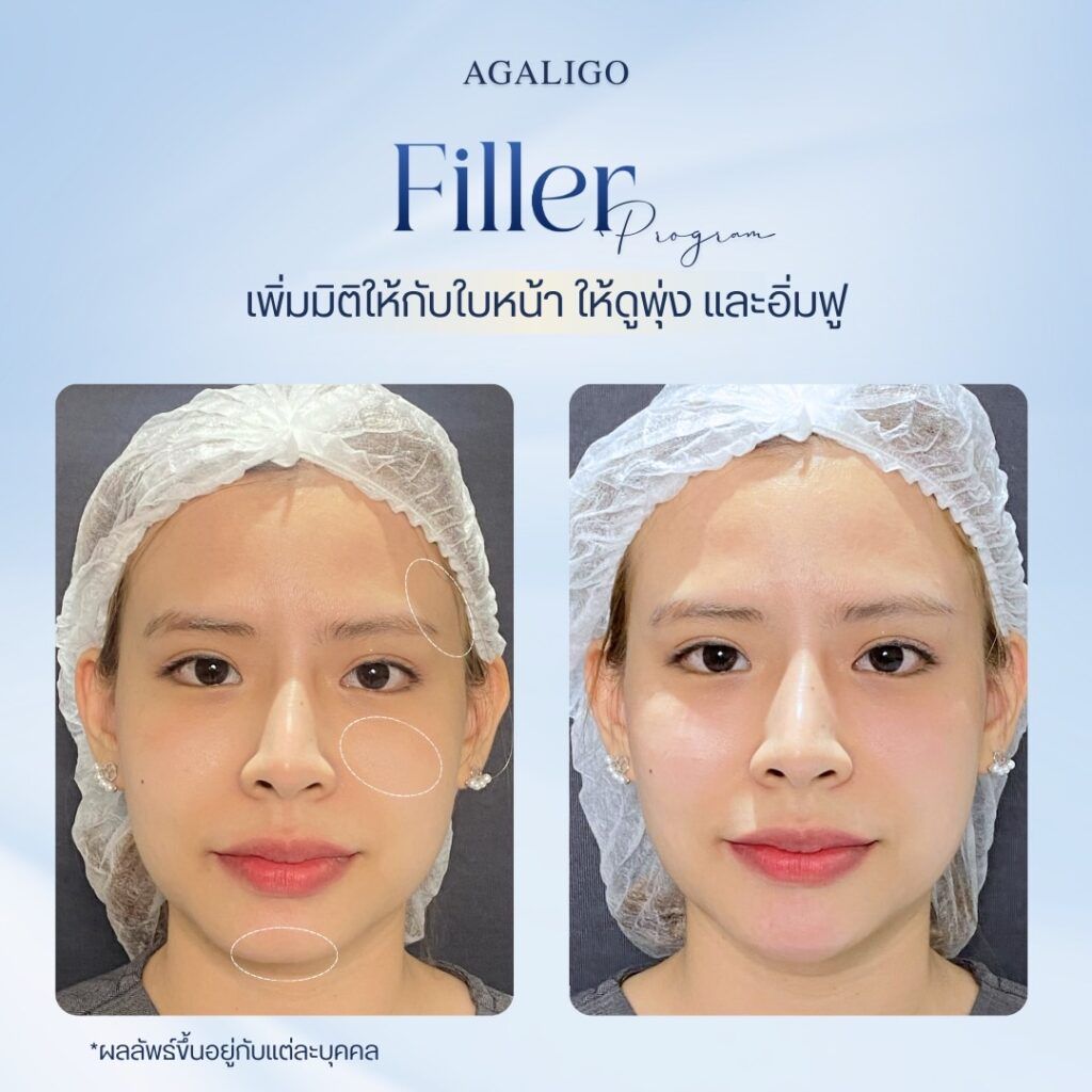 รีวิว ฉีดฟิลเลอร์ FillerReview4