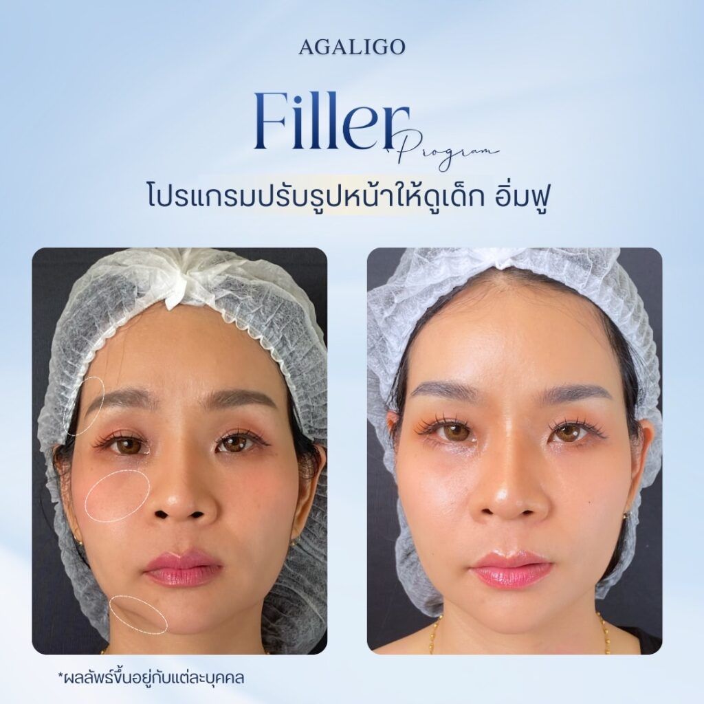 รีวิว ฉีดฟิลเลอร์ FillerReview5
