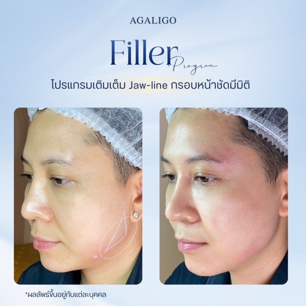 รีวิว ฉีดฟิลเลอร์ FillerReview8