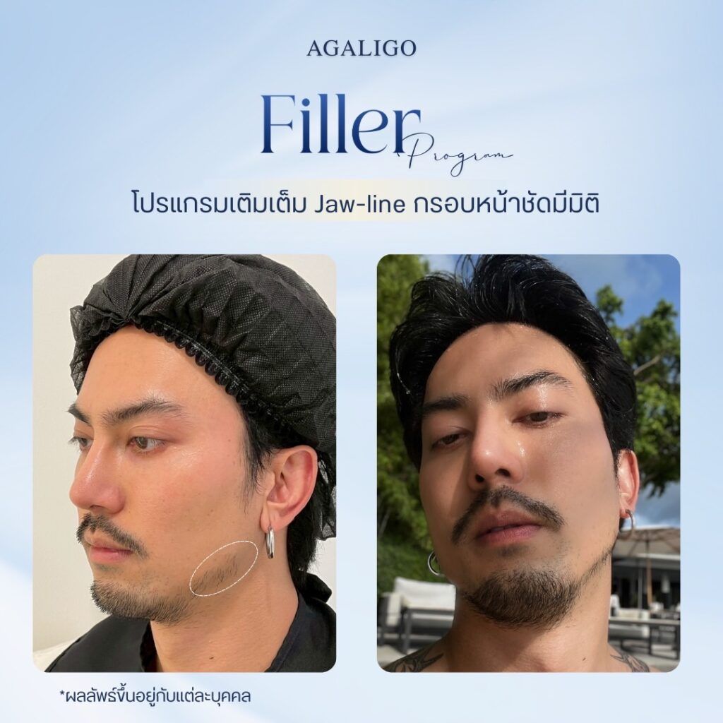 รีวิว ฉีดฟิลเลอร์ FillerReview6