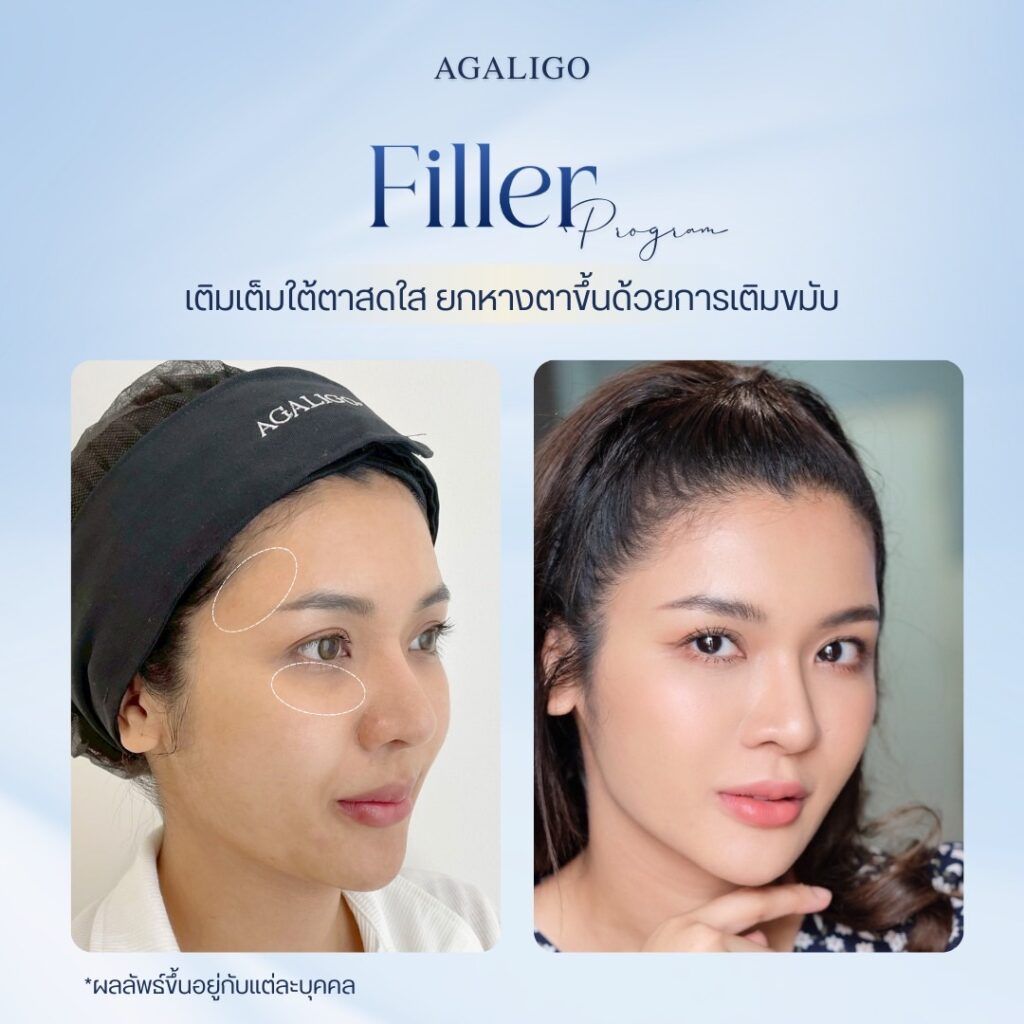 รีวิว ฉีดฟิลเลอร์ FillerReview2