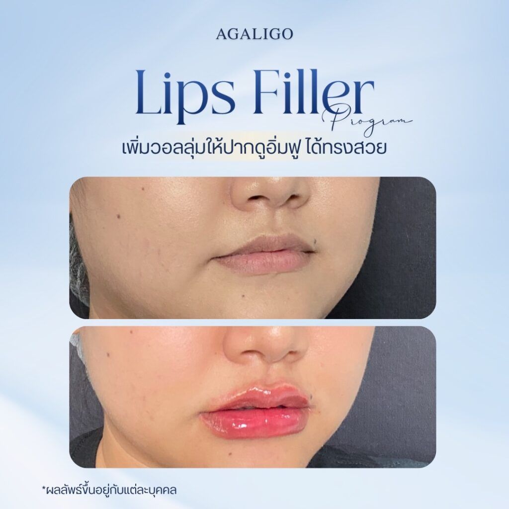 รีวิว ฉีดฟิลเลอร์ FillerReview8