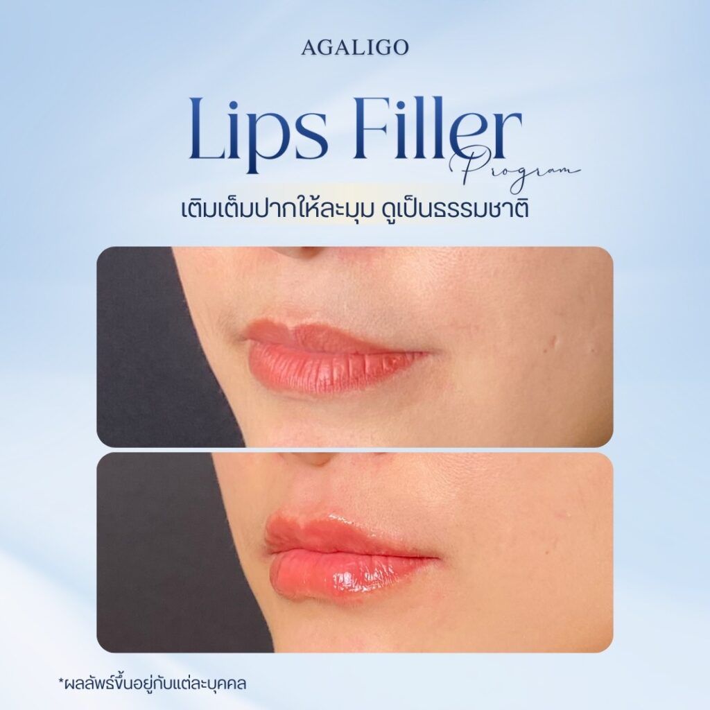 รีวิว ฉีดฟิลเลอร์ปาก FillerReview8