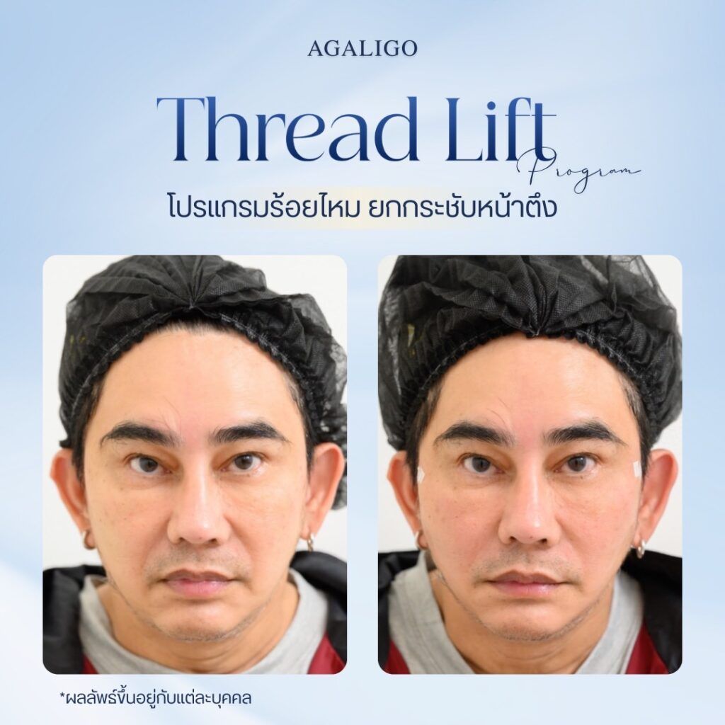 ร้อยไหม รีวิว