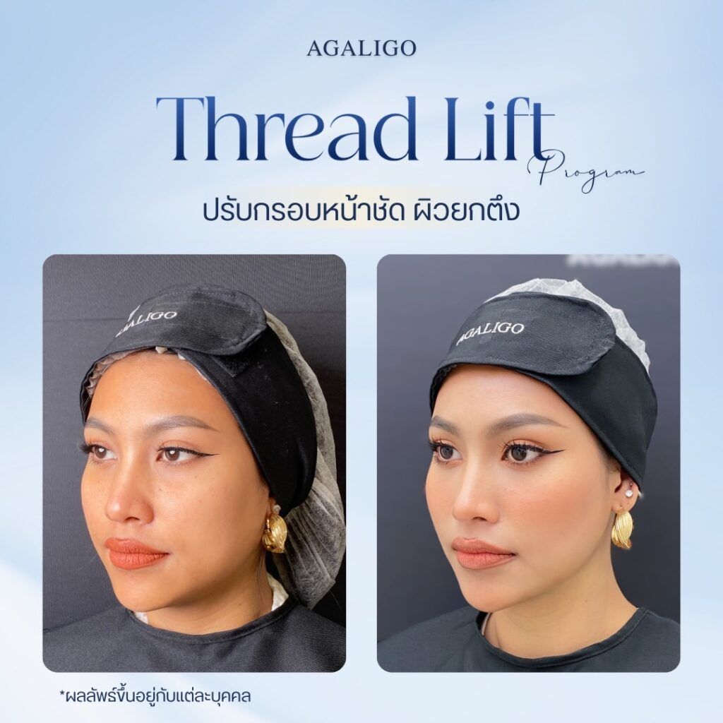 ร้อยไหม รีวิว