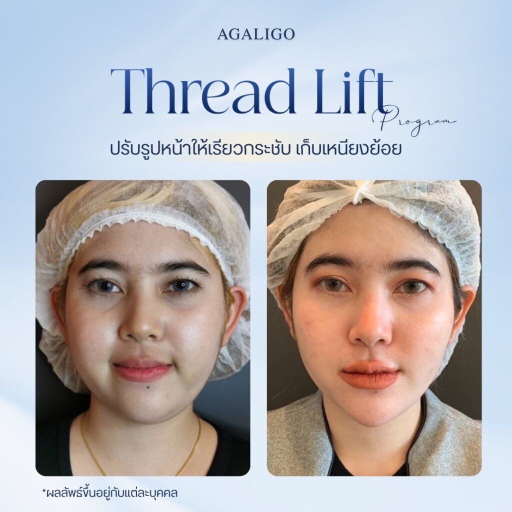 ร้อยไหม รีวิว