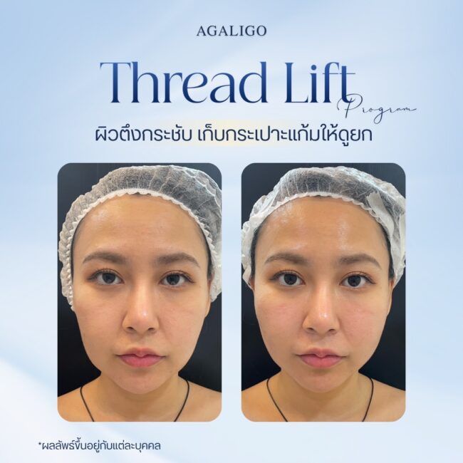 รีวิวร้อยไหม_2-4