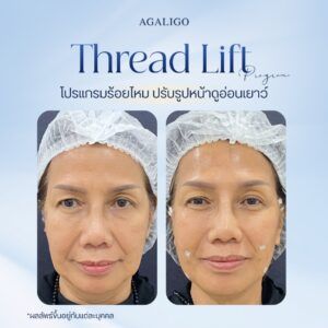 รีวิวร้อยไหม_2-6