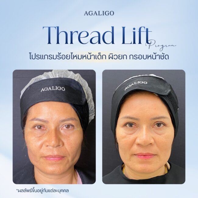 รีวิวร้อยไหม_2-8