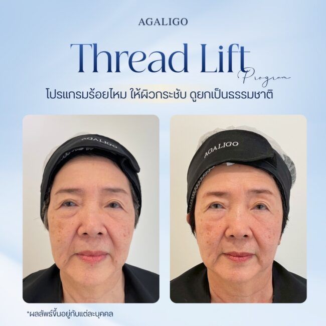 รีวิวร้อยไหม_2-9