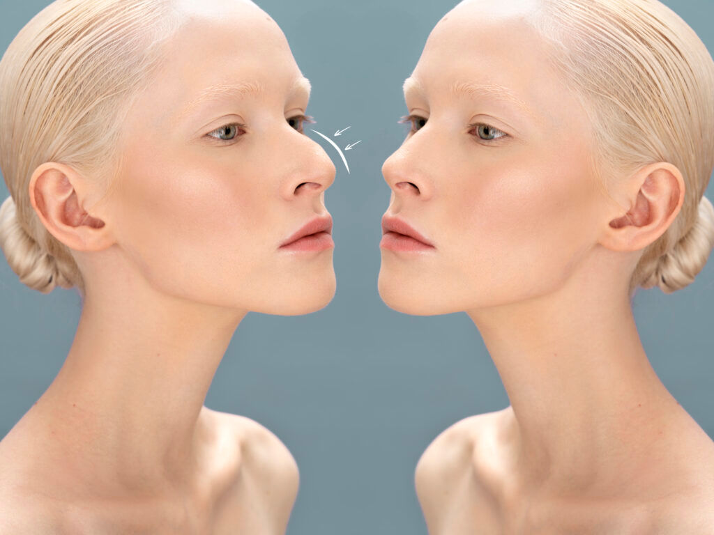 ร้อยไหม Threadlift