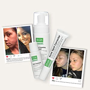 acne treatment salicylic acid benzoyl peroxide heal pimple lotion clear skin neutrogena proactiv